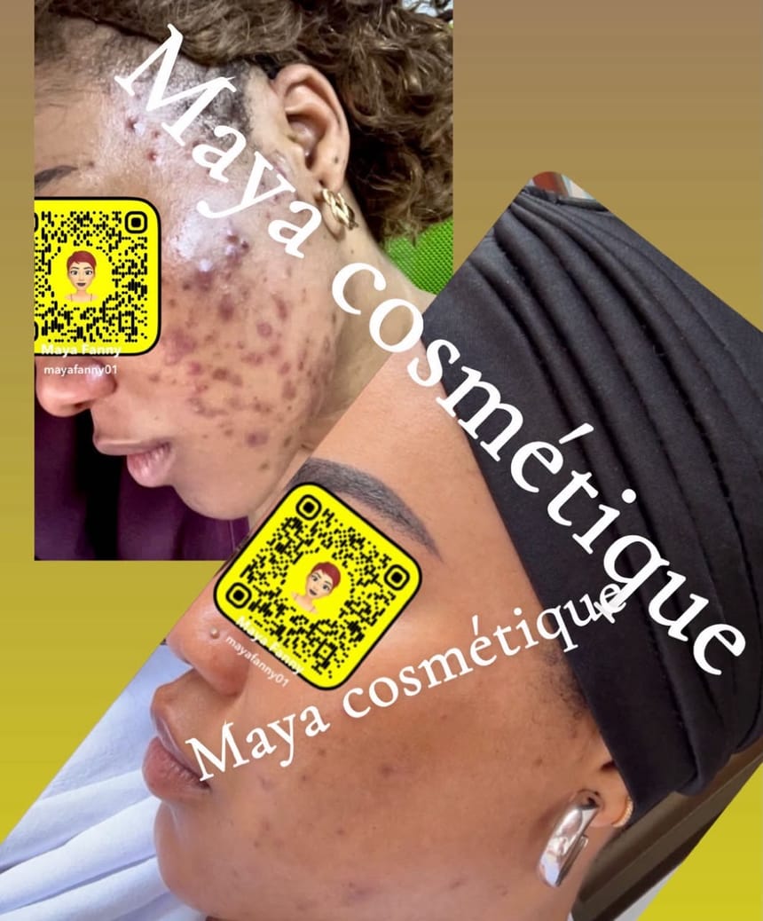 Résultat avant-après Maya Cosmétique sur le visage