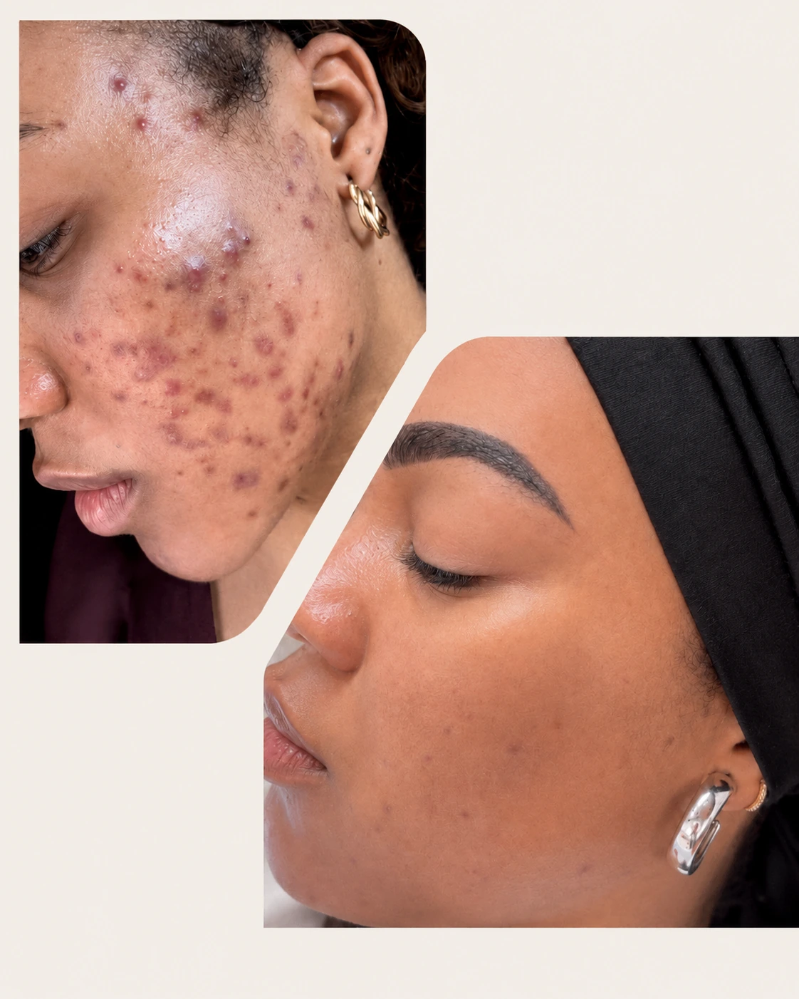 Résultat avant-après Maya Cosmétique sur le visage