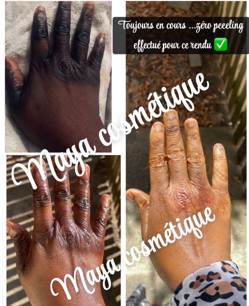 Progression avant-après Maya Cosmétique sur les mains, sans peeling