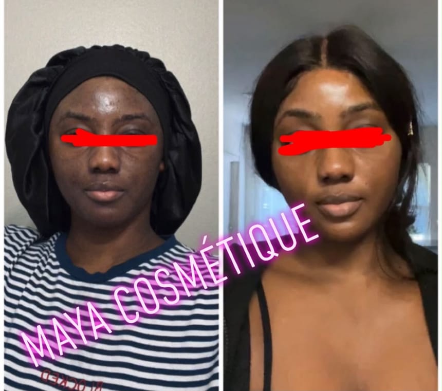 Résultat avant-après Maya Cosmétique sur le visage