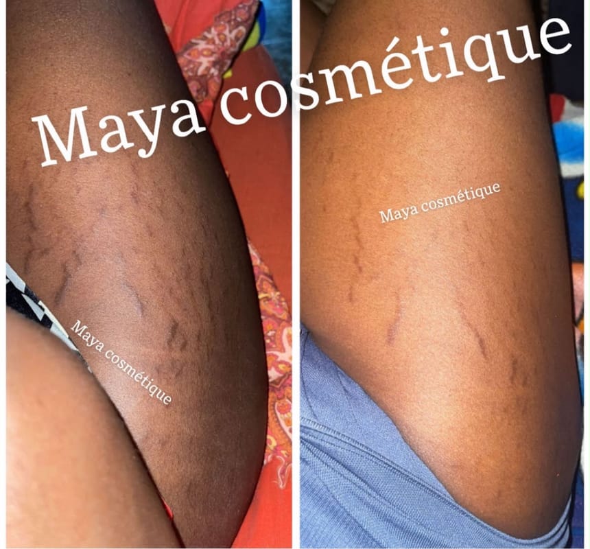 Résultat avant-après Maya Cosmétique sur les vergetures