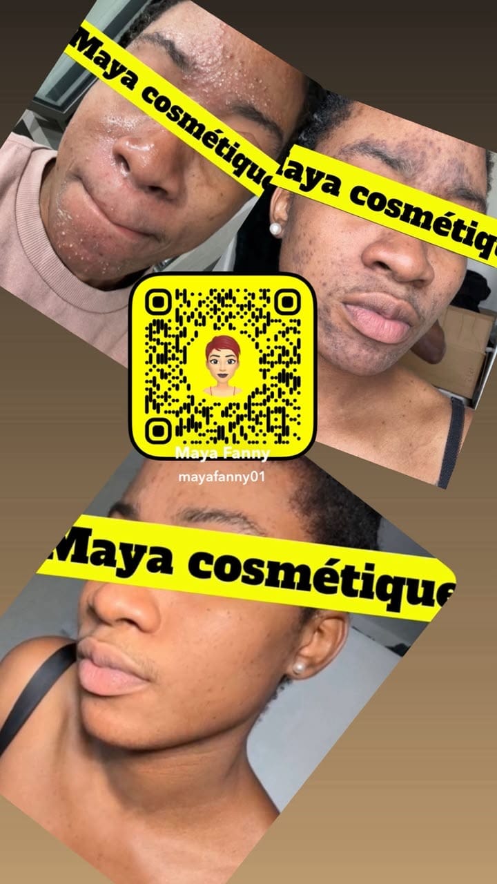 Résultat avant-après Maya Cosmétique sur les imperfections du visage